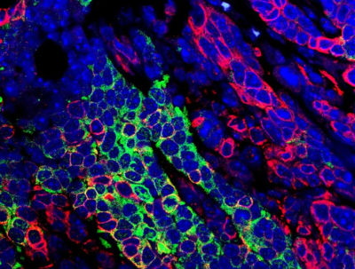 Nat Cell Biol：三阴性乳腺癌需要对“症”<font color="red">下药</font>