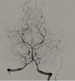 JAMA Neurol：作为取栓术的补救措施，动脉内溶栓的疗效