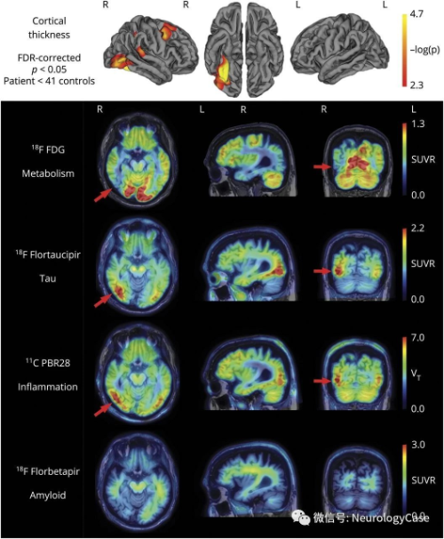 Neurology：<font color="red">后部</font>原發(fā)性進(jìn)行性面容失認(rèn)癥：結(jié)構(gòu)和分子影像學(xué)