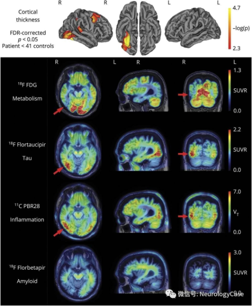 Neurology：后部原发性进行性面容失认症：结构和<font color="red">分子</font>影像学