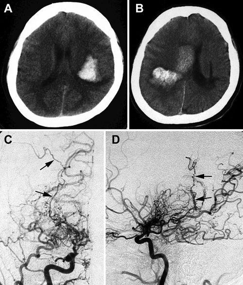 J Neurosurg：烟雾病脑室旁出血可能与脉络膜血管吻合有关