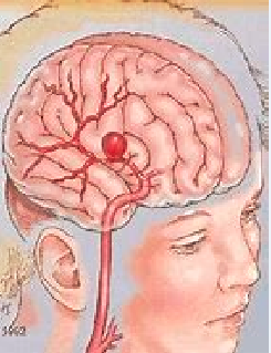 Neurology：静脉溶栓发生<font color="red">远隔</font>部位脑<font color="red">出血</font>的原因