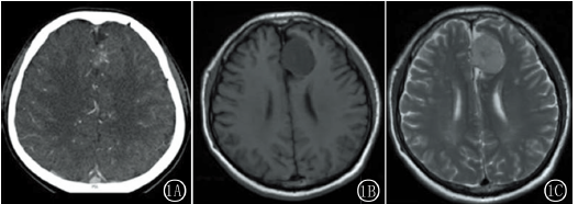 大脑镰海绵状血管瘤1例