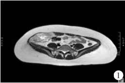 腺泡状软组织肉瘤三例磁共振成像表现