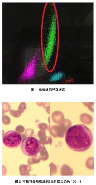 误诊为幼年型关节炎的儿童急性<font color="red">单核细胞</font>白血病1例