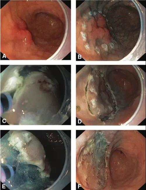 Gut：早期胃癌的内镜粘膜下剥离术出血风险评估