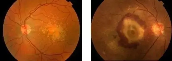 【Science】眼损伤“元凶”竟成“帮手”！通过近红外光刺激可恢复视力！