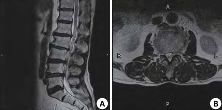 四个诊断腰椎管狭窄的MRI征象，千万不能忽视