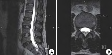 四个诊断腰椎管狭窄的mri征象 千万不能忽视 Medsci Cn