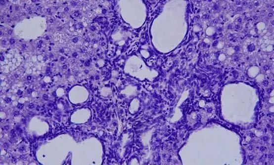 PNAS：新突破：阻断一种蛋白可抑制肝癌和<font color="red">胆管</font>癌