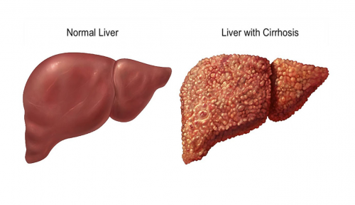 JGH Open：肝细胞癌的危险<font color="red">因素</font>总结
