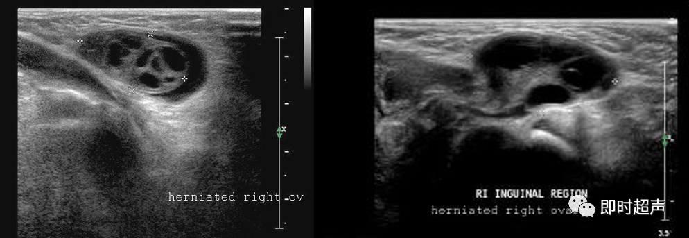 <font color="red">睾丸</font>鞘膜积液与腹股沟斜疝的超声诊断