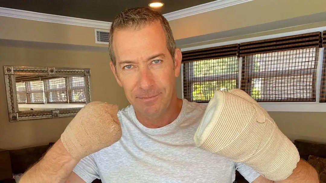 FoxNews：美国一男子因新冠肺炎重症截掉几乎所有的手指