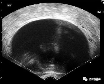 卵巢畸胎瘤超声图像图片