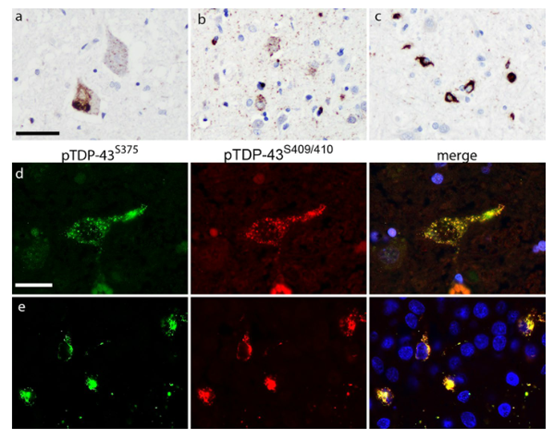 Acta Neuropathologica：丝氨酸375位磷酸化的抗TDP-43抗体提示FTLD-TDP亚型间TDP-43<font color="red">聚集体</font>的构象差异