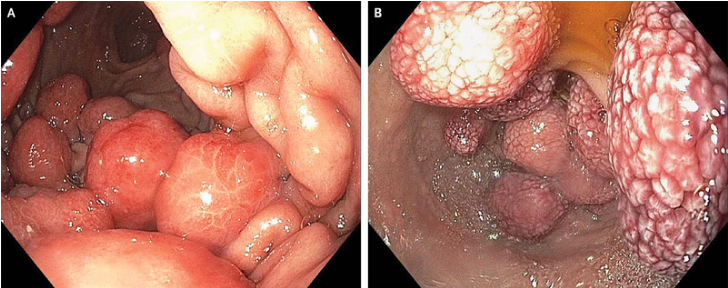 NEJM：胃肠道髓样肉瘤-病例报道