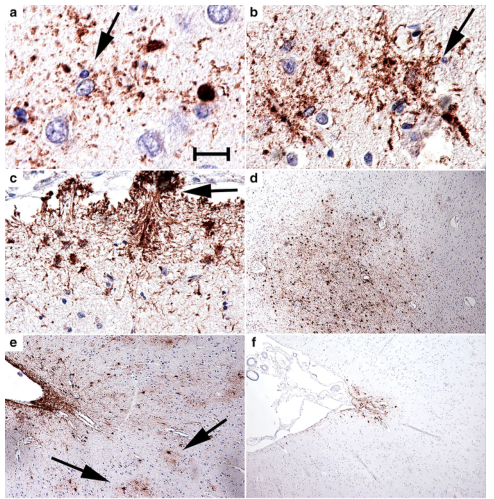 Acta Neuropathologica: 西太平洋ALS /帕金森病-痴呆综合征皮质沟深处的<font color="red">棘</font><font color="red">状</font>星形胶质细胞