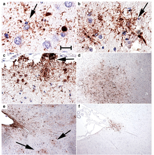 Acta Neuropathologica: 西太平洋ALS /帕金森病-痴呆综合征皮质沟深处的棘状星形胶质细胞 