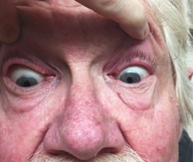 NEJM：抗Ma2脑干脑炎的斜视眼阵挛-病例报道