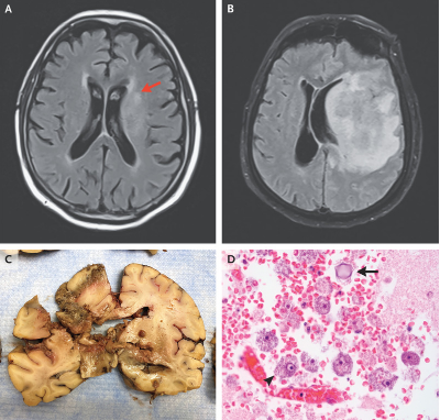 NEJM：<font color="red">肉芽肿</font><font color="red">性</font>阿米巴脑炎-病例报道