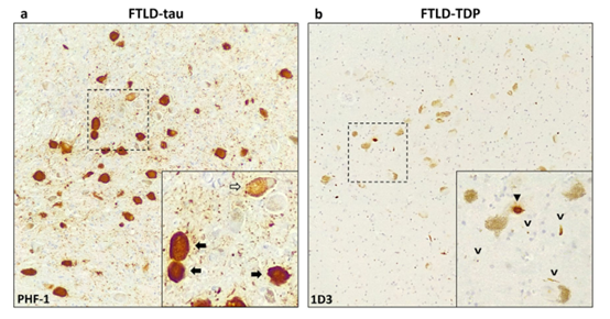 Acta Neuropathologica: 蓝斑变性是tau病的一个常见特征，与额颞叶变性谱中的<font color="red">TDP-43</font>蛋白病变不同