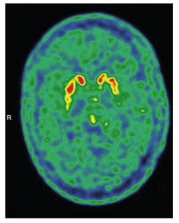 Lancet Neurology：1例SARS-CoV-2感染后疑似引起帕金森病
