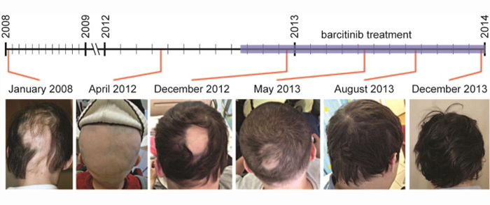 关节炎药物JAK抑制剂Baricitinib治疗斑秃：患者获得显著改善