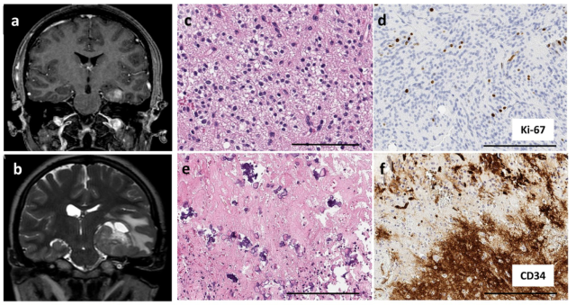 Acta Neuropathologica: <font color="red">青少年</font>多形低度神经上皮瘤（PLNTY）的恶性转化