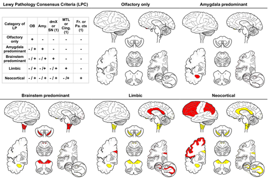 Acta Neuropathologica: 评估死后大脑<font color="red">路易</font>病理学的神经病理学共识标准: 一项多中心研究