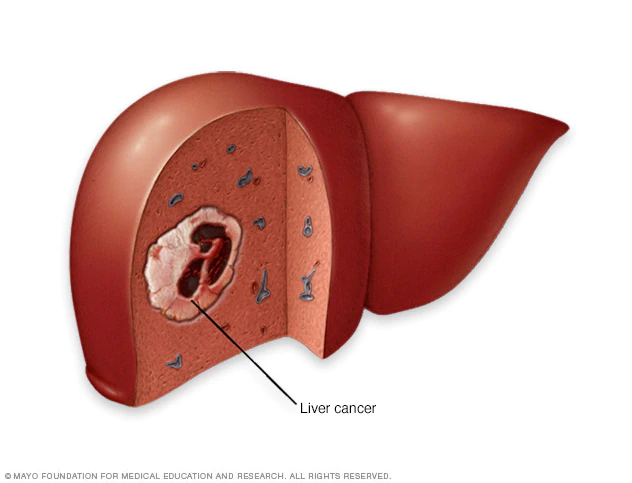 Liver cancer - Symptoms and causes - Mayo Clinic
