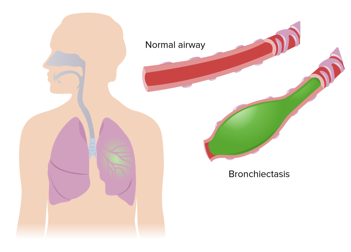 Bronchiectasis | Concise Medical Knowledge