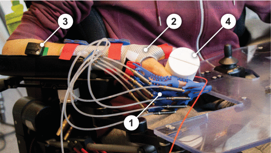 Fig. 1. - The participant with DMD grasping the sensorized object while wearing SymbiHand orthosis. 1) SymbiHand, consisting of four finger modules. 2) The thermoplastic hand splint, used to stabilize the wrist and thumb while providing an anchoring surface for the four finger modules. 3) Wireless sEMG sensor, placed on the extensor digitorum communis muscle. 4) The cylindrical sensorized object, used for measuring grasping force.