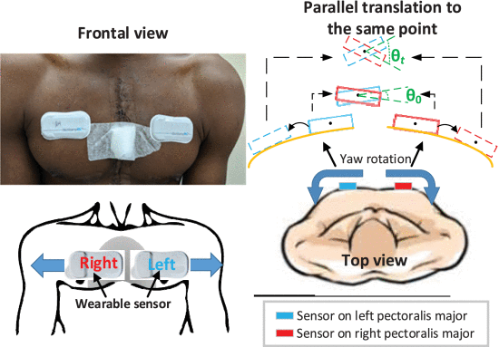 Fig. 1. - Sensors attached to a post-sternotomy patient subject and sensor movements corresponding to chest skin expansion during sit-to-stand transitions.