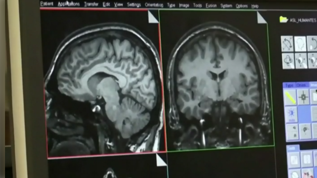 N.B. launching investigation into nearly 50 cases of mystery neurological  disease | CTV News
