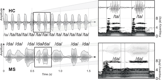 Fig. 1. - Example of voiceless and (top) and voiced (bottom) AMR task with zoom to the oscillographic sound pressure signal and its respective spectrogram for two syllables with highlighted positions of burst and vowel occlusion by hand labels. An exemplary HC speaker (top) performed syllable repetition at a fast tempo (DDK rate = 8.1 syll/s) and stable regularity (DDK regularity = 3.7 ms), whereas the exemplary MS patient manifested slow velocity (DDK rate = 5.9 syll/s) and irregularity (DDK regularity = 60.5 ms). MS = multiple sclerosis, HC = healthy controls.