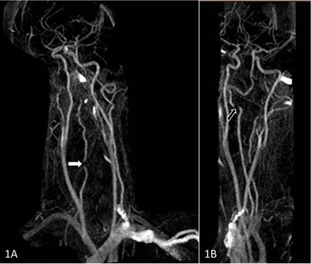 JNNP:弓亨特综合征：一例双侧椎动脉动态闭塞的罕见病例