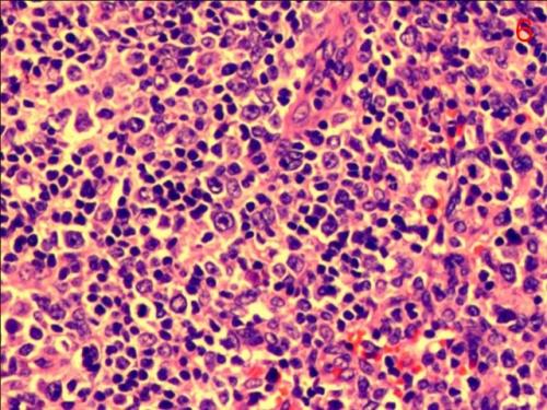 J Hematol Oncol：PD-1单抗---杰诺单抗注射液(geptanolimab）对外周T细胞淋巴瘤(<font color="red">PTCL</font>) 的疗效与安全性