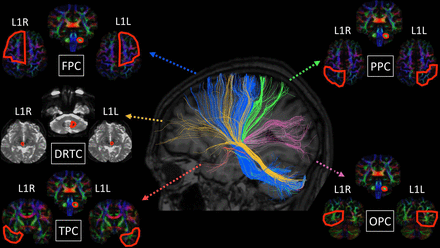 JNNP:ALS的基因型<font color="red">相关</font>小脑特征：局灶性小脑病理学和大脑-小脑连接改变