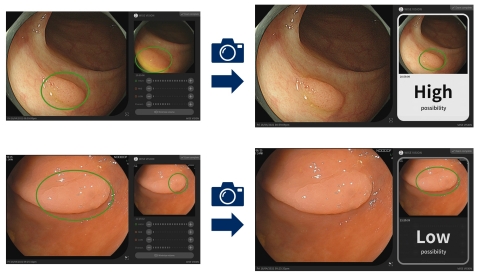 Cx20功能支持病变识别：在检查过程中，通过内镜器械拍摄的视频自动检测疑似病灶。然后医生提取静止图像（左），快速分析并显示结果（右）（图示：美国商业资讯）
