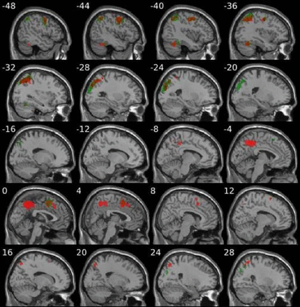 JNNP：视雪综合征患者局部脑灌注增加：一项伪连续动脉自旋标记研究