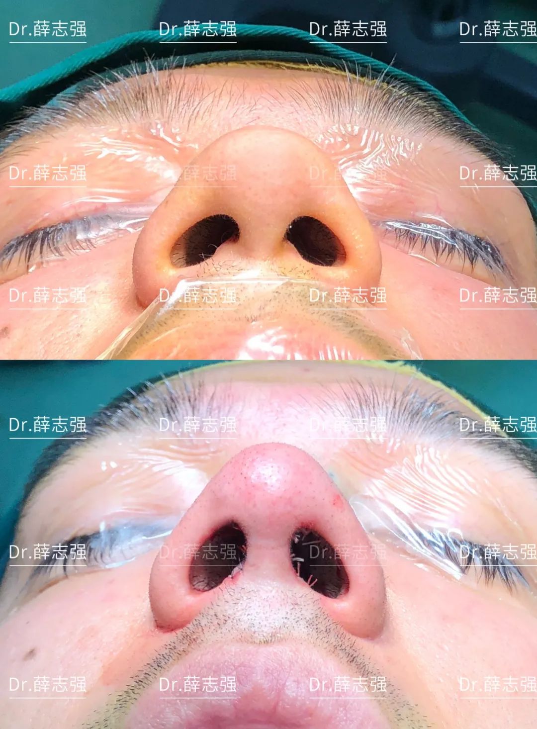 鼻综合案例对比，塌鼻子男生做完隆鼻收获一大堆迷妹 _圈子-新氧美容整形