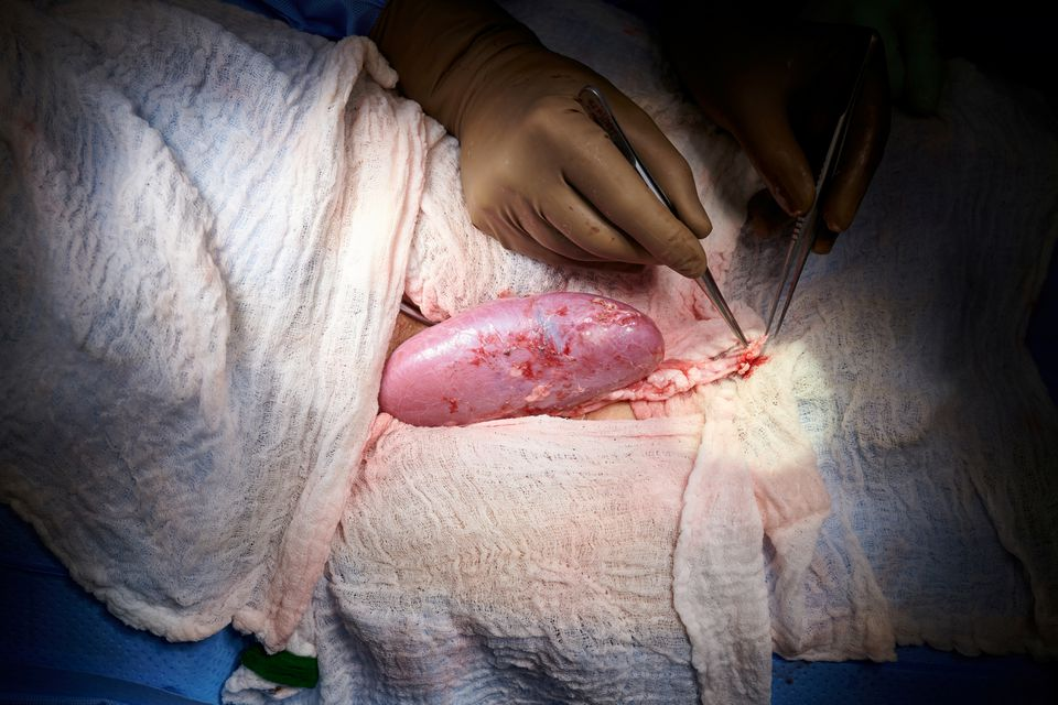 世界首例猪肾移植到人体，暂未发现排斥反应！异种移植成真了？