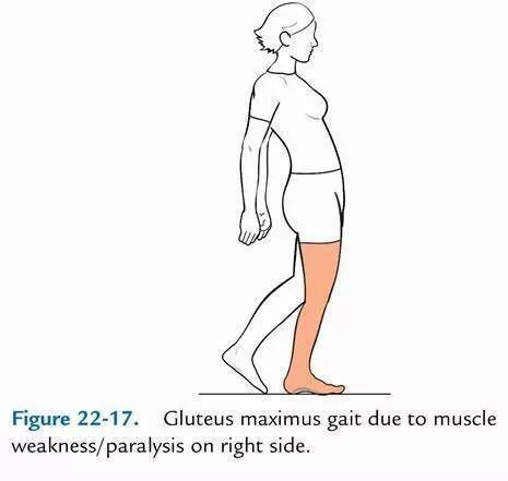 2,臀大肌无力步态——棘旁肌收缩具体表现为单侧短缩,一侧骨盆前倾