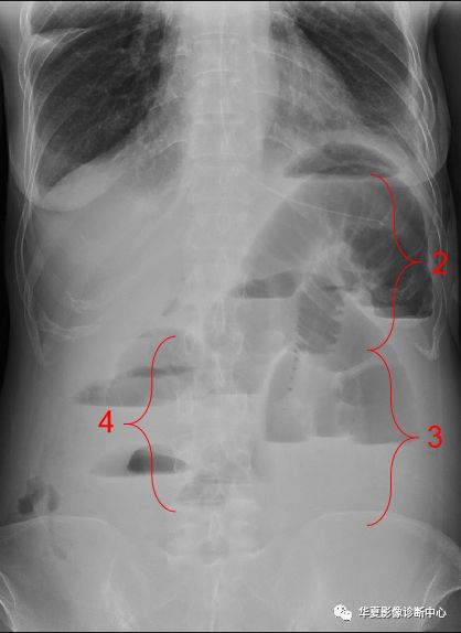腹部平片肠梗阻图片图片