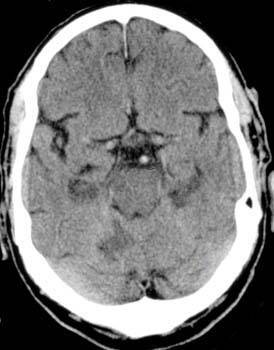 如何通过头颅CT识别早期脑梗死？