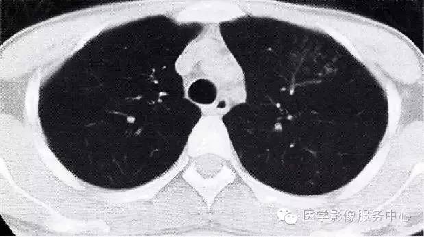 肺部<font color="red">炎症</font>常见的“七大”CT表现
