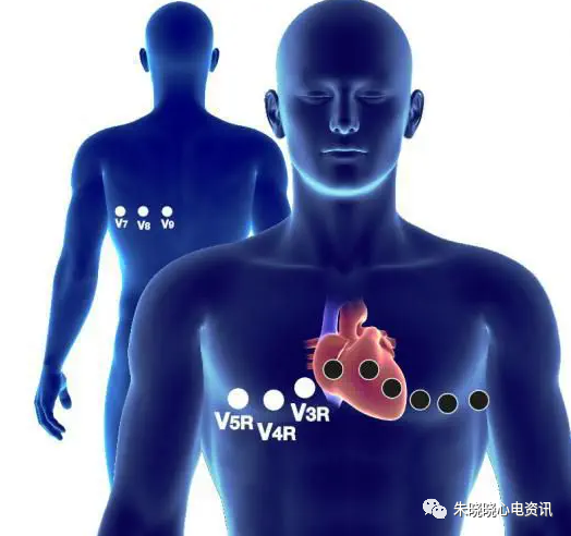 在急性胸痛患者中，综合后右胸前胸心电图的临床意义
