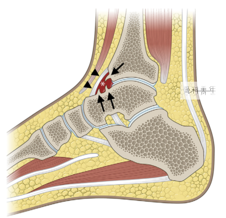 详解｜5大踝关节撞击综合征的<font color="red">解剖</font>因素、影像表现、诊断与治疗