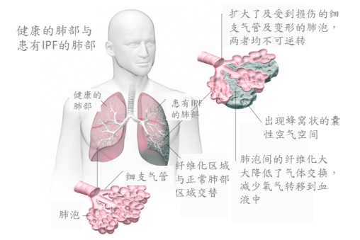 特发性肺纤维化病死亡率高突破性治疗增加用药期存活率_讯康网