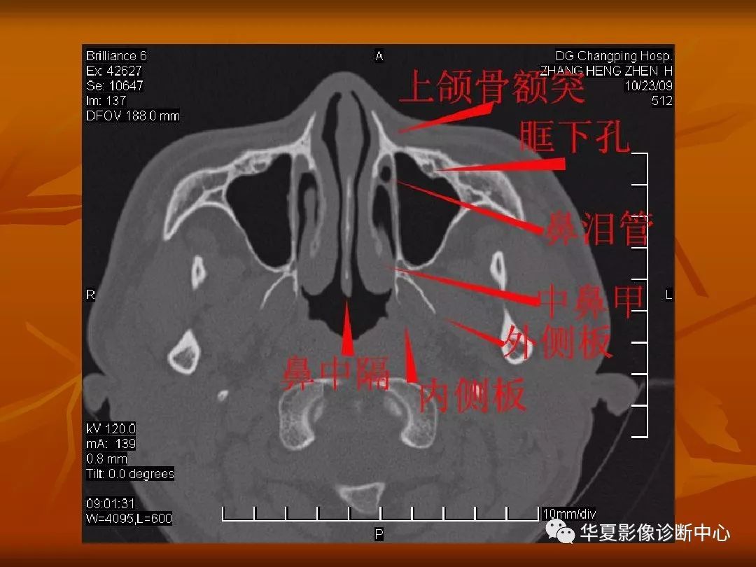 面颅骨CT解剖图片